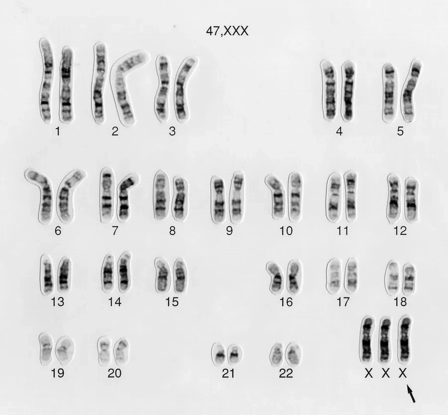 Ở người mắc hội chứng Triple X, công thức nhiễm sắc thể là 47,XXX