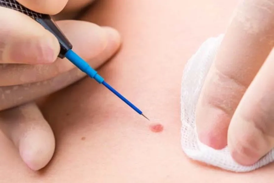 Đốt điện giúp loại bỏ các nốt sùi nổi rõ trên bề mặt da hoặc niêm mạc