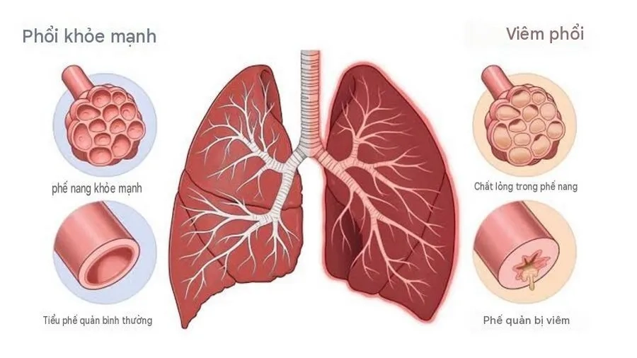 Hình ảnh mô phỏng phổi bình thường và phổi bị viêm