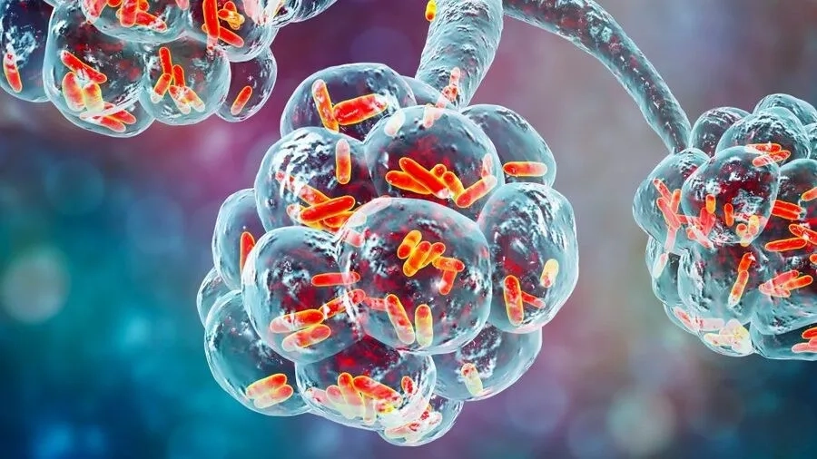 Hình ảnh minh họa tổn thương phổi do nhiễm khuẩn Streptococcus pneumoniae 