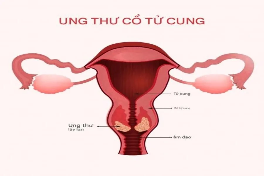 tiêm hpv có kiêng quan hệ không