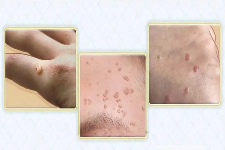 quan hệ rồi tiêm hpv có tác dụng không